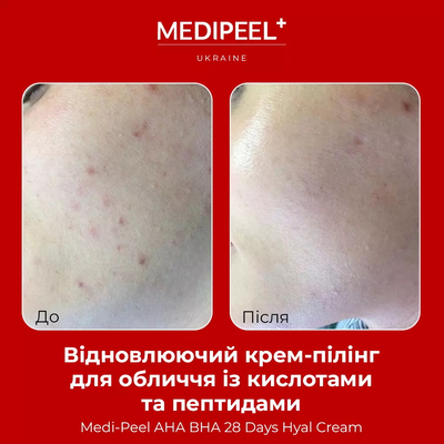 Крем-пилинг для лица восстанавливающий с кислотами Medi-Peel AHA BHA 28 Days Hyal Cream